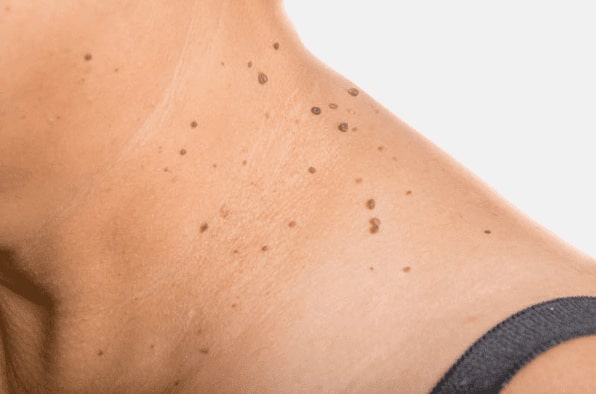 Are you looking for easy skin tag removal Knowle Grove - then contact Spire today!