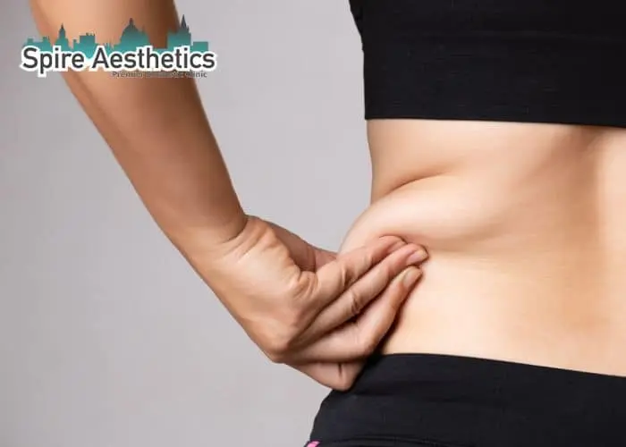 Image of woman pinching fat on their hips Knowle Grove. Fat Freezing treatment