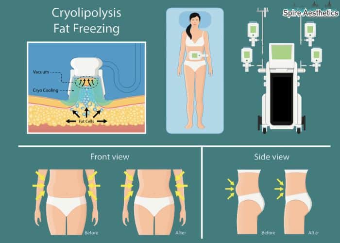 Image of diet and fat freezing combined for best results for Spire Aesthetics Knowle Grove