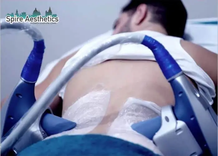 Man having fat freezing treatment done on love handles before a competitions Knowle Grove to create a sculpted look.