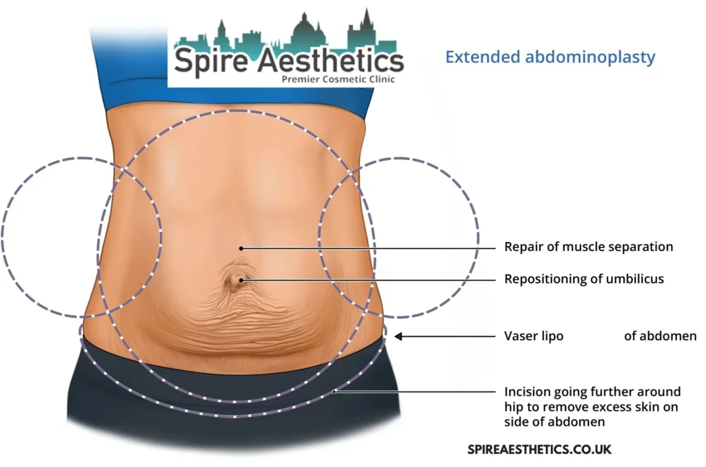 Understanding Loose Skin After Gastric Band Knowle Grove Surgery and HIFU Treatment