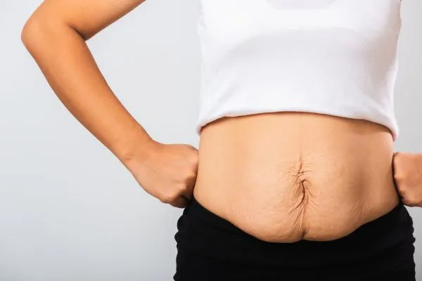 Image of a woman's stomach after weight loss with sagging skin following a gastric band Knowle Grove