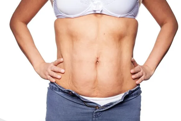 sagging skin on woman's stomach after weight loss injections Knowle Grove