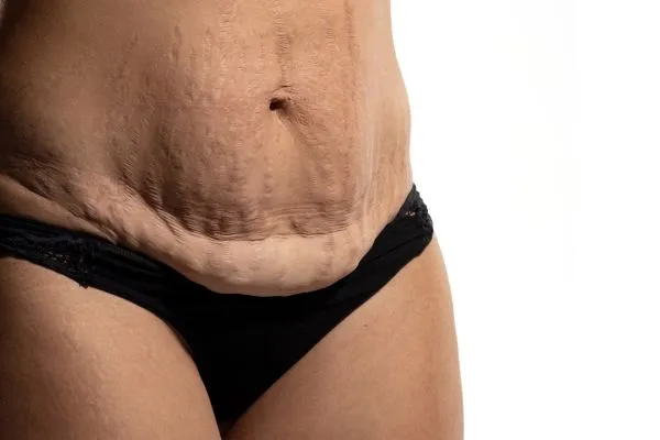 Image of womans stomach after weight loss injections Knowle Grove showing saggy skin